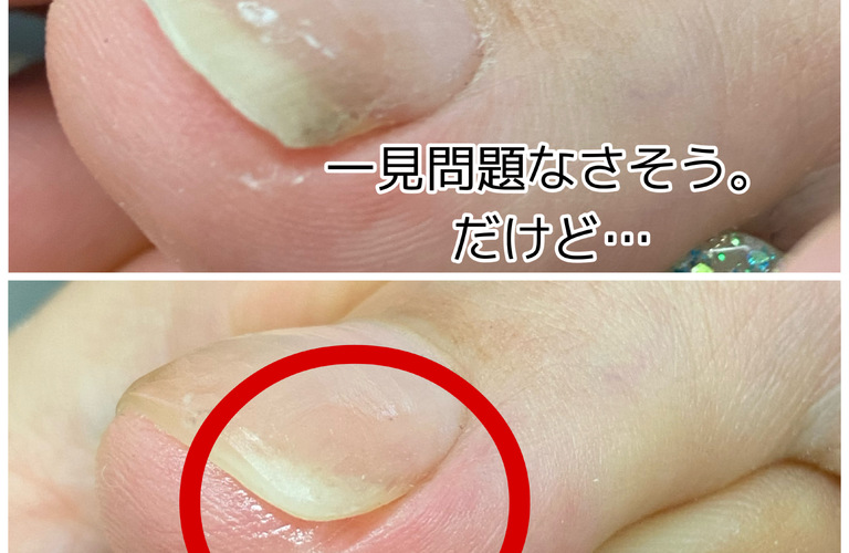 爪の食い込み